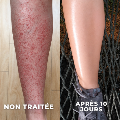 Gommage anti peau de fraise