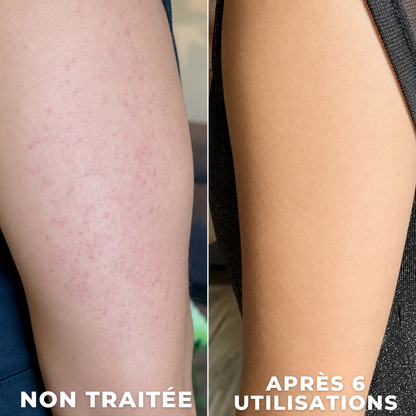 Gommage anti peau de fraise